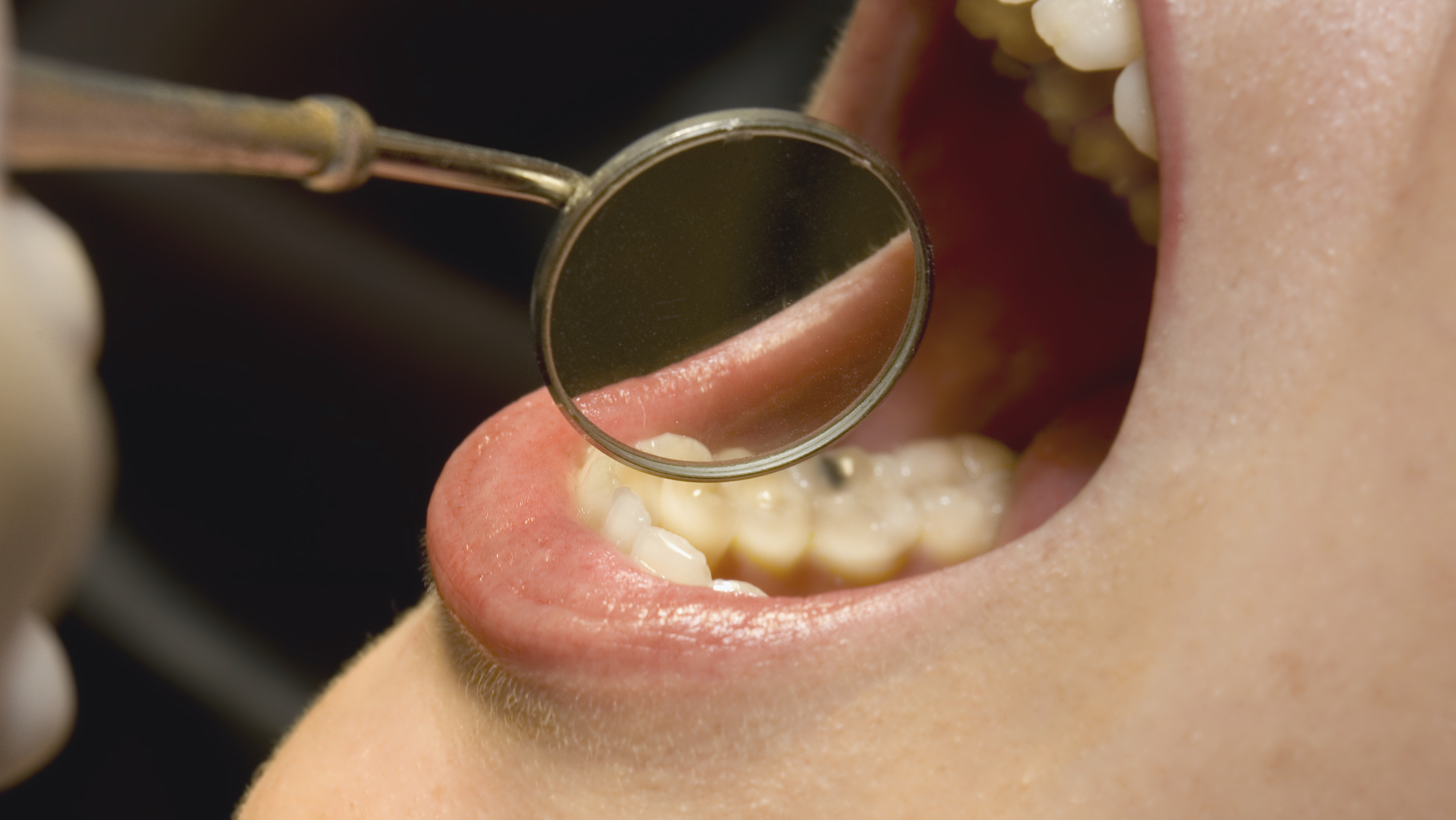 Oral Cancer Screening 62695888cfc5d