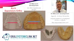 Figure 1: Dr. Mike Mulligan had his arch expanded by approximately 8 mm and 3 mm anterior/posterior at the age of 62. Figure 1: Dr. Mike Mulligan had his arch expanded by approximately 8 mm and 3 mm anterior/posterior at the age of 62.