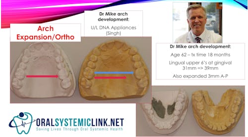 Figure 1: Dr. Mike Mulligan had his arch expanded by approximately 8 mm and 3 mm anterior/posterior at the age of 62.