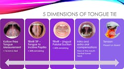 Figure 2: 5 dimensions of tongue tie