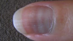 Figure 2: Mee's lines (18) Figure 2: Mee's lines (18)