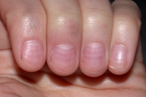 what causes horizontal ridges in fingernails
