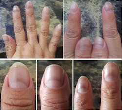 Figure 4: Red half-moon nails associated with COVID-19 infection (20) Figure 4: Red half-moon nails associated with COVID-19 infection (20)
