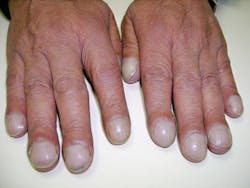 Figure 6: Digital hypertrophic osteoarthropathy, commonly known as clubbed fingers (21)