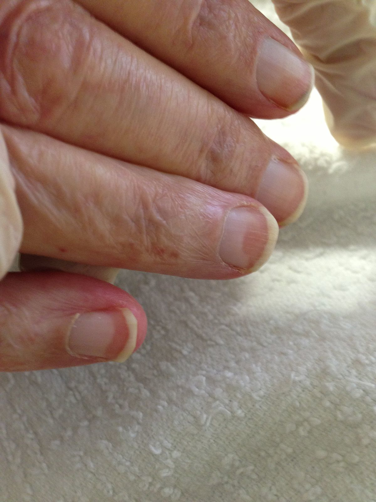 Nails Changes and Disorders in Elderly Libyans