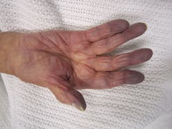 Figure 8: Cyanosis of the hand in someone with low oxygen saturations (23) Figure 8: Cyanosis of the hand in someone with low oxygen saturations (23)