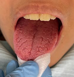Figure 1: Fissured tongue in a 14-year-old female Figure 1: Fissured tongue in a 14-year-old female
