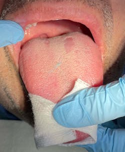Figure 2: Geographic tongue in a 43-year-old male