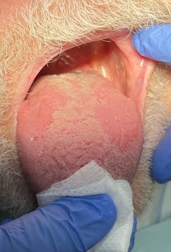 Figure 3: Hairy tongue in an 85-year-old male Figure 3: Hairy tongue in an 85-year-old male
