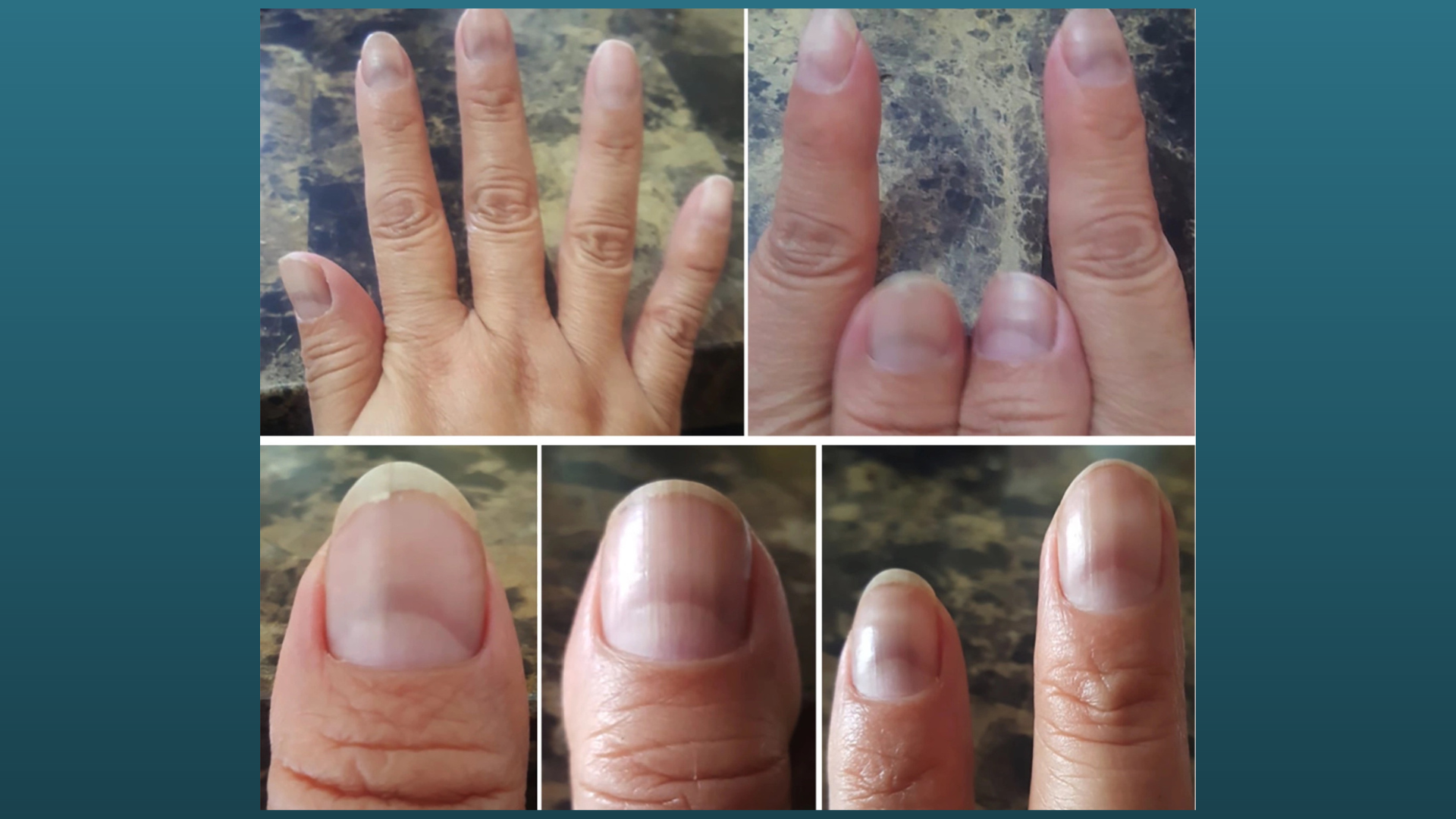 7 nail symptoms and conditions you shouldn't ignore - TODAY