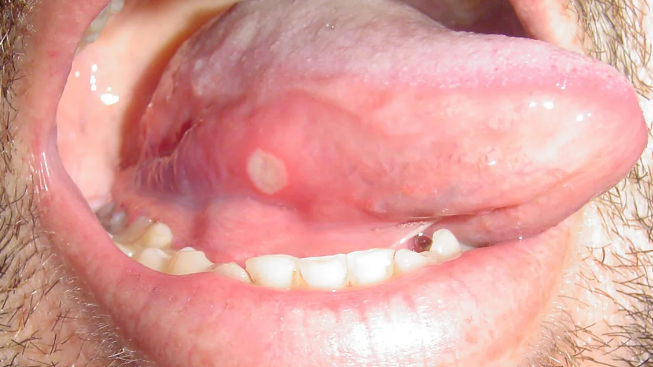 aphthous stomatitis tongue