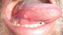 Figure 1: Aphthous ulcer