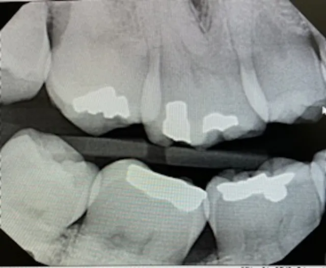 Techniques to reduce horizontal overlap in dental x-rays | Registered ...