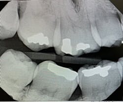 Figure 1. Poor horizontal radiograph with horizontal overlap Figure 1. Poor horizontal radiograph with horizontal overlap