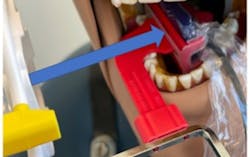 Figure 2. Good horizontal radiograph with Rinn XCP placement directed through the proximal surfaces Figure 2. Good horizontal radiograph with Rinn XCP placement directed through the proximal surfaces