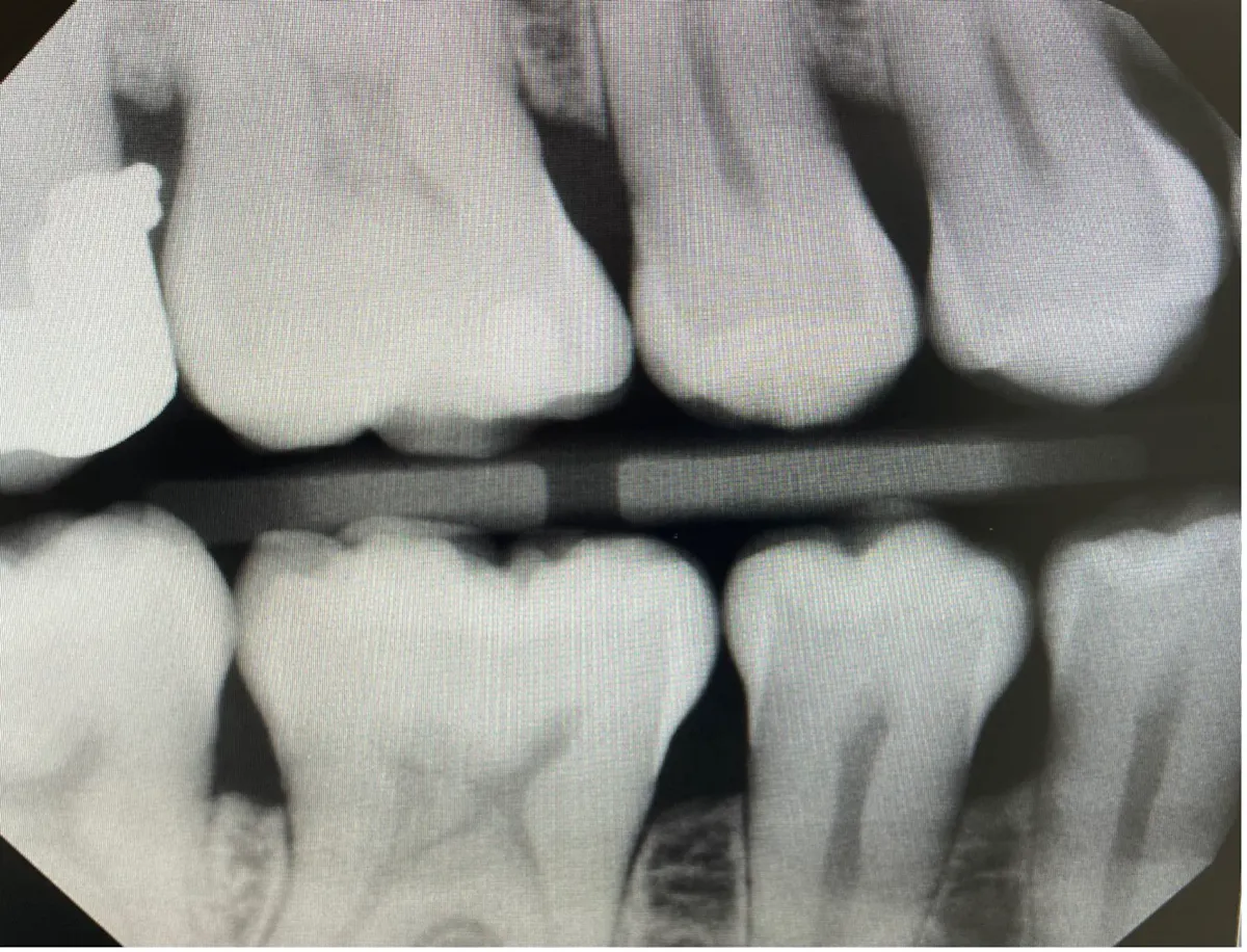 Techniques to reduce horizontal overlap in dental x-rays | Registered ...
