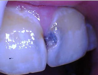 Figure 1a: Oral dysbiosis: dental caries
