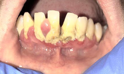 Figure 1b: Oral dysbiosis: necrotizing periodontitis