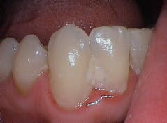 Figure 2: Oral biofilm Figure 2: Oral biofilm
