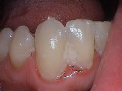 Figure 2: Oral biofilm