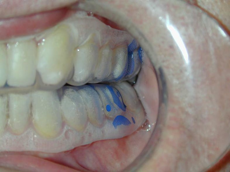 Figure 5: Perio Tray and Gel on teeth