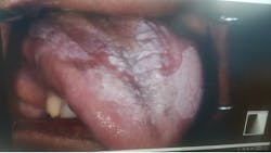 Figure 10: Proliferative verrucous leukoplakia Figure 10: Proliferative verrucous leukoplakia