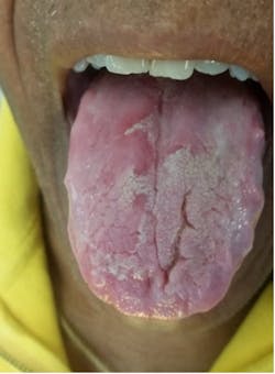 Figure 11: Migratory glossitis Figure 11: Migratory glossitis