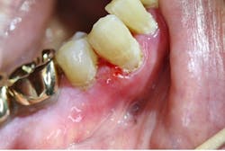 Figure 12: Cicatricial pemphigoid Figure 12: Cicatricial pemphigoid