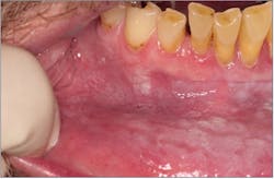 Figure 2: Smokeless tobacco keratosis Figure 2: Smokeless tobacco keratosis