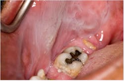 Figure 3: Leukoedema Figure 3: Leukoedema