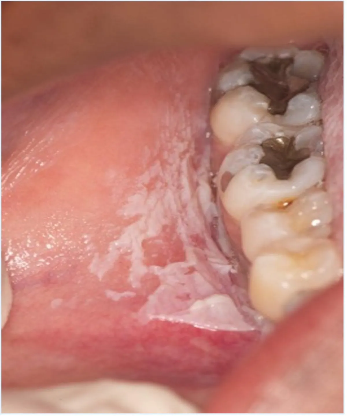 White lesions of the oral cavity and oralsystemic health A review for
