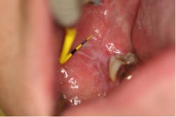 Figure 7: Lichen planus Figure 7: Lichen planus