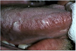 Figure 8: Oral hairy leukoplakia Figure 8: Oral hairy leukoplakia
