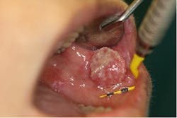 Figure 9: Squamous cell carcinoma Figure 9: Squamous cell carcinoma