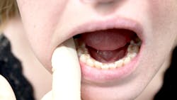 Oral Cancer 6447f5d39f6fa Oral Cancer 6447f5d39f6fa