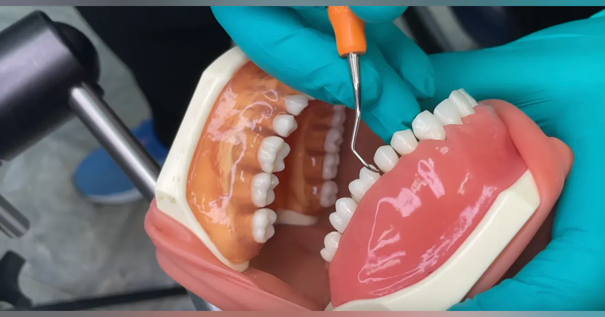 Differences between 11/12 and 15/16 Gracey Curettes | Registered Dental ...
