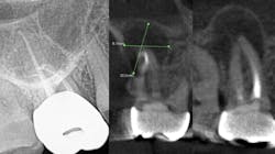 Figure 1: Periapical x-ray and CBCT scan of a lesion of endodontic origin Figure 1: Periapical x-ray and CBCT scan of a lesion of endodontic origin