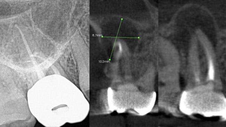 Figure 1: Periapical x-ray and CBCT scan of a lesion of endodontic origin