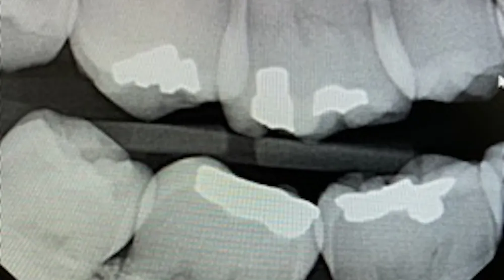 Techniques to reduce horizontal overlap in dental x-rays | Registered ...