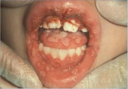 Figure 2: Primary herpes simplex Figure 2: Primary herpes simplex