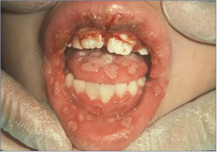 Figure 2: Primary herpes simplex
