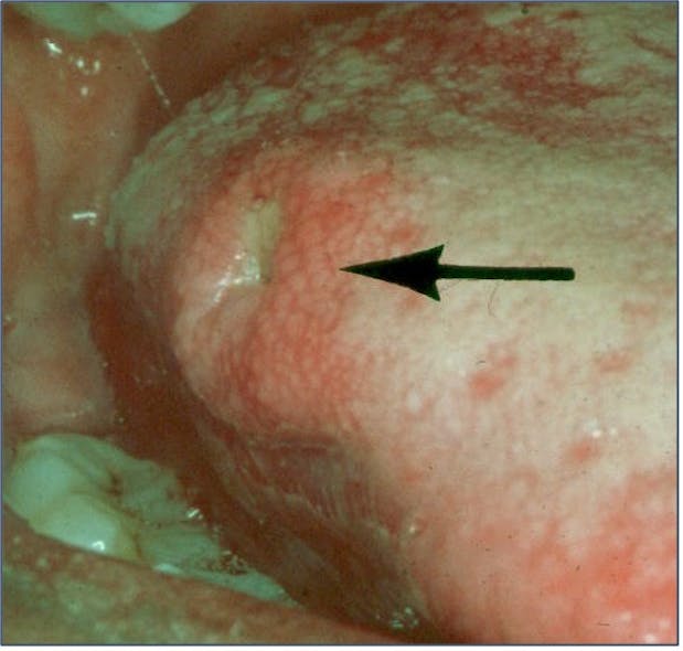 Figure 4: Tertiary syphilis (gumma)