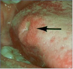 Figure 4: Tertiary syphilis (gumma)
