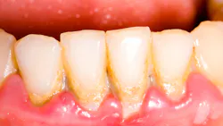 Is there a link between tartar buildup and a lack of vitamin K2?