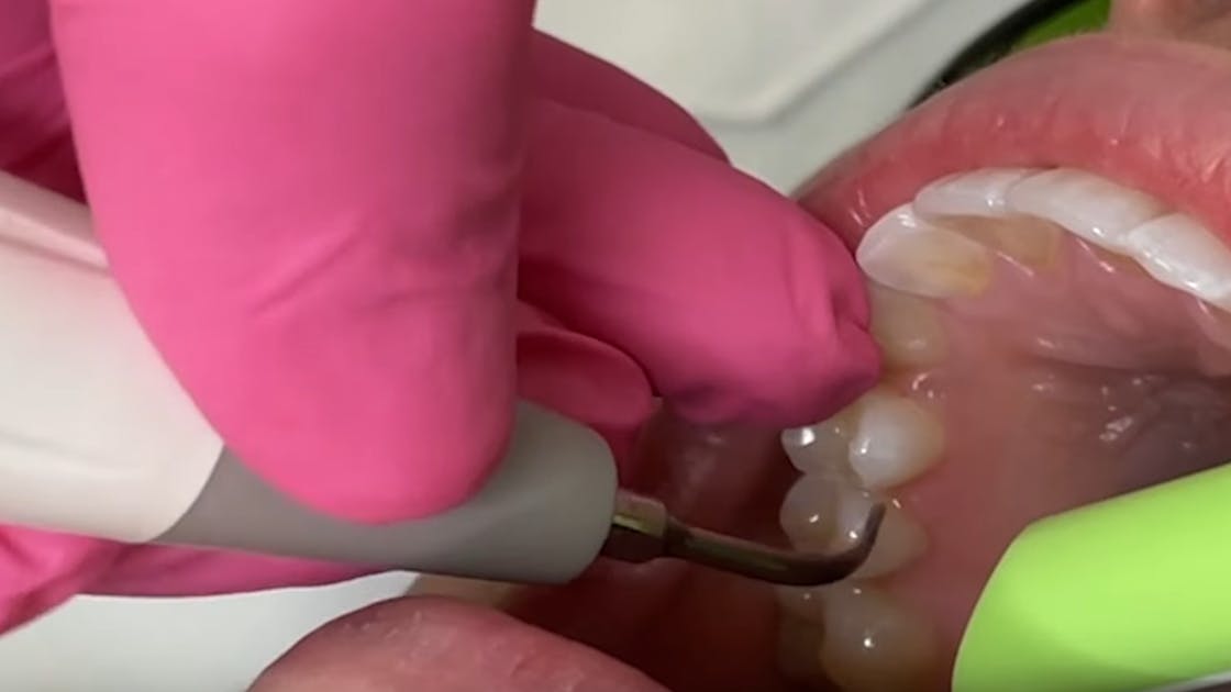 5 Commonly Performed Dental Treatment Procedures - Roderick A