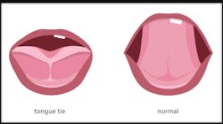 Tongue Tie 64d28170b0cfb Tongue Tie 64d28170b0cfb