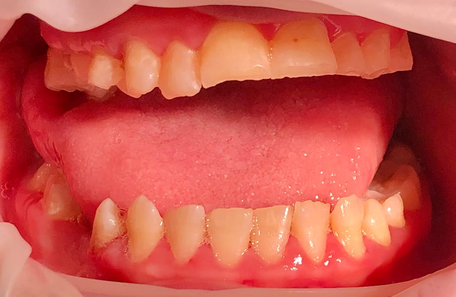 Figure 3: Katie has a large tongue that often covers her teeth while her mouth is open.