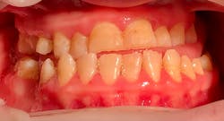 Figure 4: Katie has an anterior and posterior crossbite. Figure 4: Katie has an anterior and posterior crossbite.