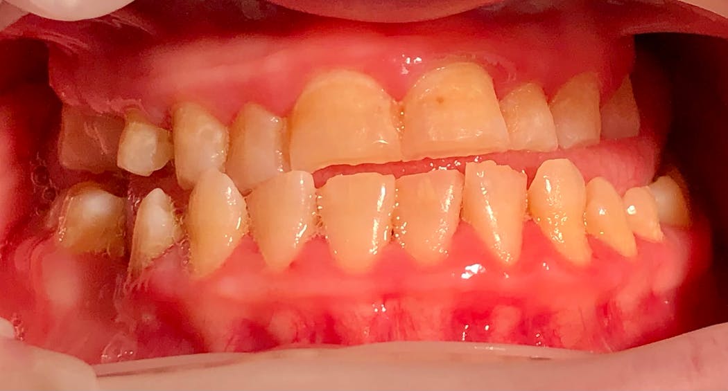Figure 4: Katie has an anterior and posterior crossbite.