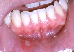 Figure 5: Aphthous ulcer Figure 5: Aphthous ulcer